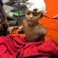পল্লী বিদ্যুতের অবহেলায় বিদ্যুৎস্পৃষ্ট স্কুলছাত্র তামিমের বাম হাত কেটে ফেলতে হয়েছে